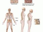 Osteoporosi.jpg